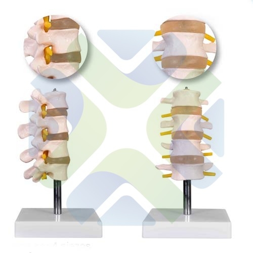 VERTEBRA LUMBAR CON SACRO, COXIS Y HERNIA DE DISCO