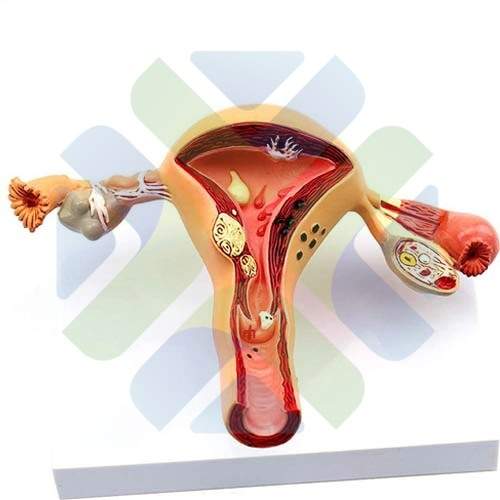 MODELO ANATOMICO DE TERO CON PATOLOGIAS 
